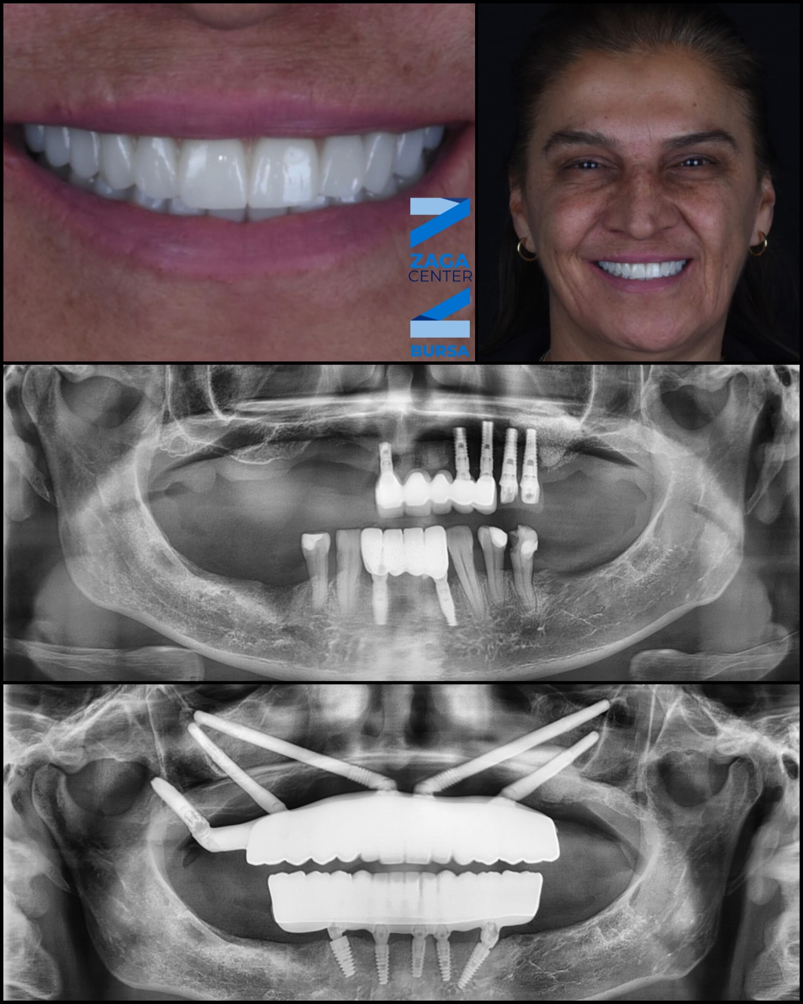 Zygomatic Implants Case Study